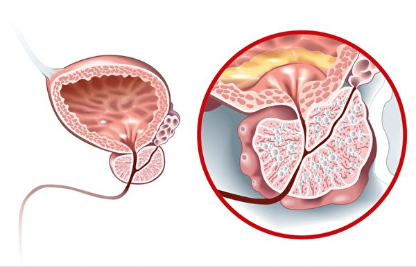 How to prevent prostate hypertrophy and prostate cancer?